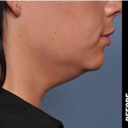 Ultherapy Before & After Patient #1548